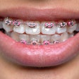 Braces Pink Bands 400