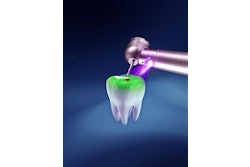 2025 09 12 Lares Uv Handpiece 400