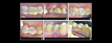 2025 09 17 Partial Fixed Denture Longevity 400