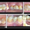 2025 09 17 Partial Fixed Denture Longevity 400