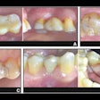 2025 09 17 Partial Fixed Denture Longevity 400