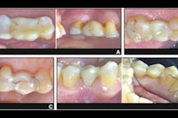 2025 09 17 Partial Fixed Denture Longevity 400