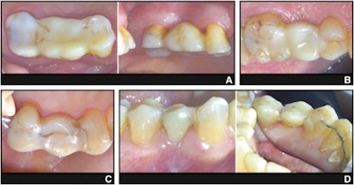 Representative photographs of four different directly fiber-reinforced composite fixed partial dentures (DFRC-FPD). (A) DFRC-FPD replacing left maxillary second premolar, supported by first premolar and first molar; in function for 13 years. Fiber bundles partially visible, but restoration clinically intact. (B) DFRC-FPD replacing left maxillary first molar, supported by second premolar and second molar; in function for 12 years, without clinical signs of failure. (C) DFRC-FPD replacing left maxillary second premolar, supported by canine and first molar; showing unilateral fracture after six years, likely associated with occlusal overload and shearing forces. (D) DFRC-FPD replacing right mandibular second premolar, supported by first premolar and first molar; showing bilateral fracture after nine years, attributed to accidental occluding on olive pit. DFRC-FPD, direct fiber-reinforced composite fixed partial denture.