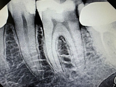 Symptomatic irreversible pulpitis with symptomatic periapical periodontitis.