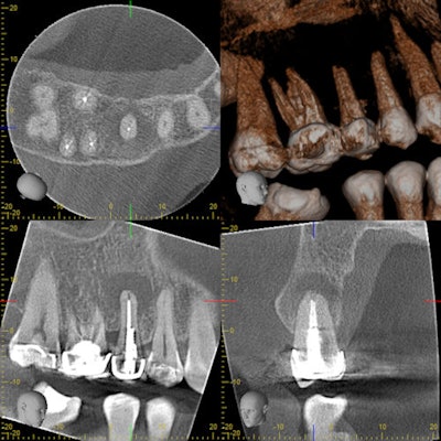 The CBCT indicates an acute apical abscess on a prior endodontically treated tooth.