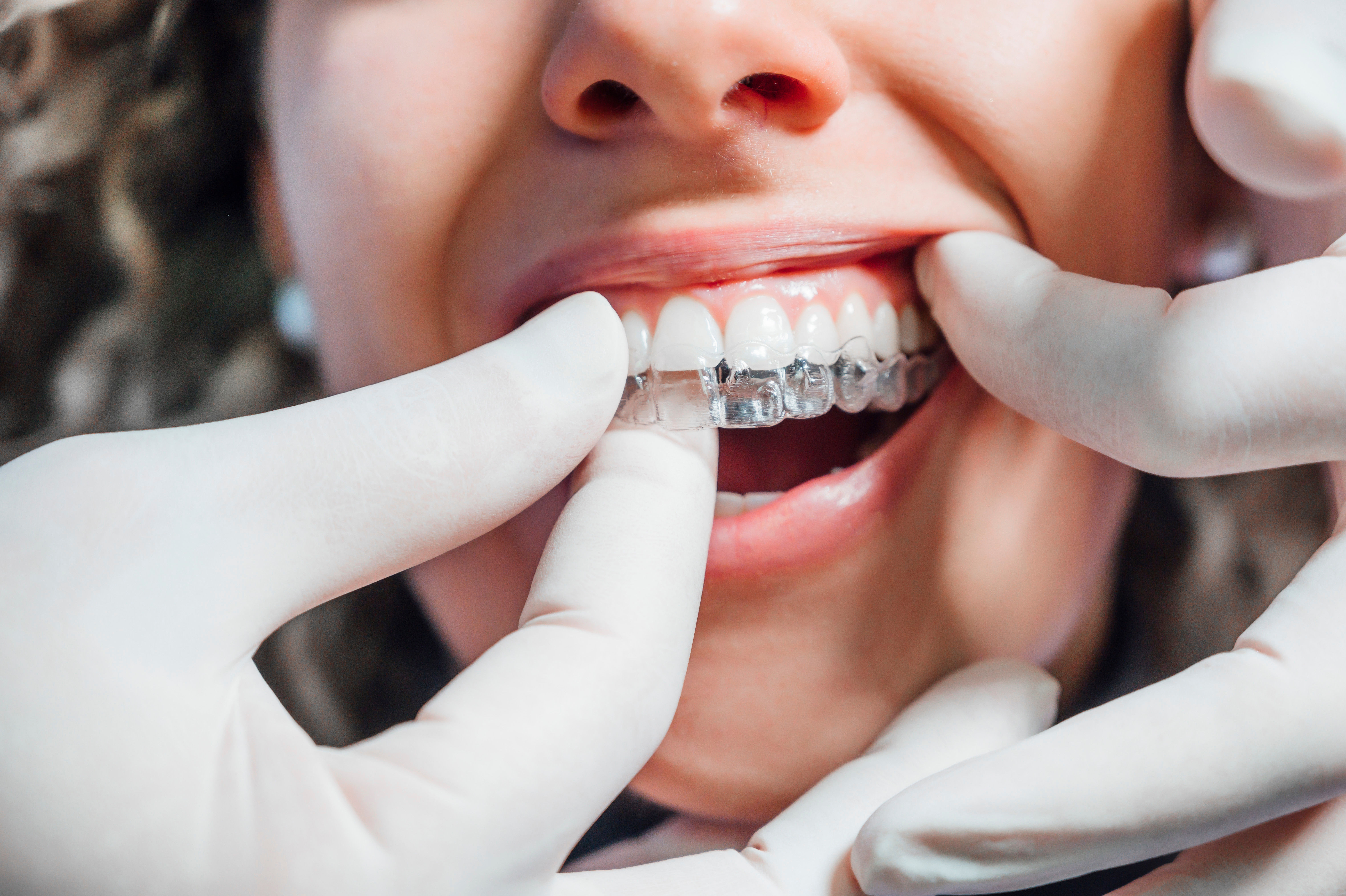 Dentist Installing Aligner Karrastock