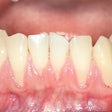 Gingival Recession Kasama