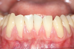 Gingival Recession Kasama
