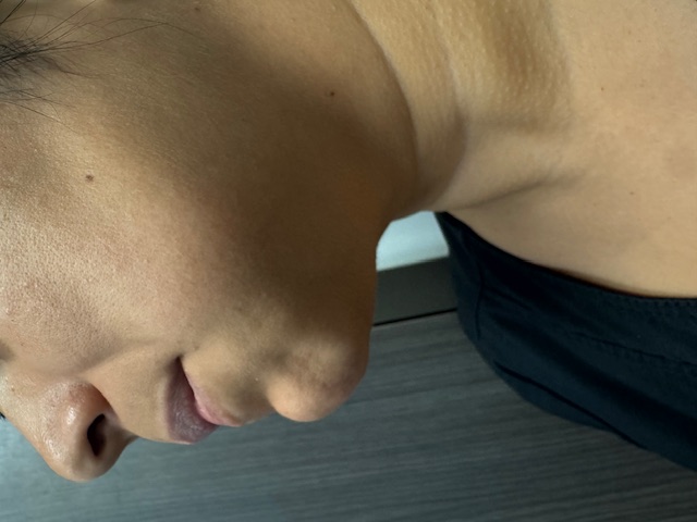 A patient presents with an abscess.