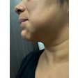 A patient presents with an abscess.