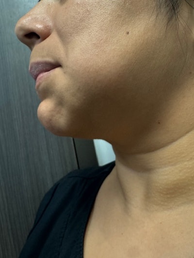 A patient presents with an abscess.