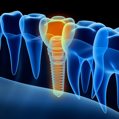 Implant 3 D 400