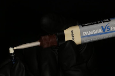 Figure 10: Cementation with Panavia V5 Opaque.