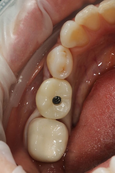 Figure 12: The screw-access channel with crown attached.