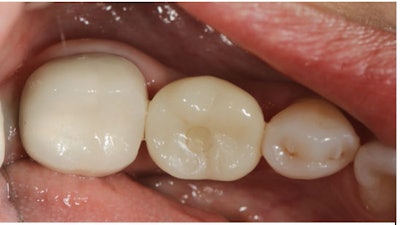 Figure 13: The screw-access channel was sealed using Clearfil Majesty ES-2 composite to maintain aesthetics and function.