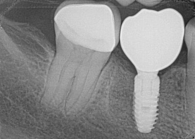 Figure 14: Final radiograph showing seated restoration.