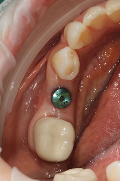 Figure 2: The healing abutment in place.