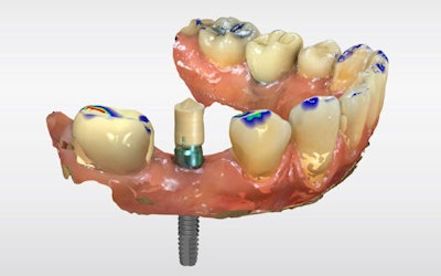 Figure 3: ScanPost placement for digital impression.