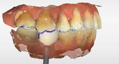 Figure 5: Virtual articulation and occlusal analysis.