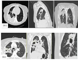 2025 10 29 Pyopneumothorax 400