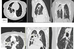 2025 10 29 Pyopneumothorax 400