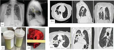 Figure 1: (a) Initial chest x-ray upon presentation showing extensive heterogeneous right lung opacity, which appears to be a thick-walled cavitary lesion about 4.8 × 10.5 cm. Moderate right loculated hydropneumothorax at the lung base with associated air-fluid level, concerning for empyema. (b) b1: A thick-walled cavitary consolidation or lesion in the posterior right upper lobe. There is a complex moderate right pleural effusion with air-fluid levels, concerning for empyema. There is extensive parabronchial thickening in the right lung. b2: CT chest after chest tube insertion; the yellow marker is pointing to a bronchopulmonary fistula, which was the reason for her continuous air leakage. (c) Frank pus after inserting the chest tube. (d) Right upper lobe abscess after lobectomy.