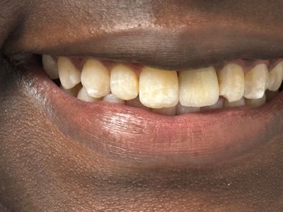 Figure 11a-11: Final restoration of tooth #9.