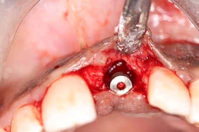 Figure 2-11: Initial uncovering of the implant reveals the need for additional augmentation to achieve an adequate soft tissue profile. A palatal releasing incision was made to avoid scarring in the aesthetic zone, followed by full-thickness reflection to the facial bone in preparation for hard and soft tissue augmentation.