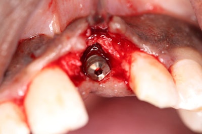Figure 3-11: Residual defect -- or 'moat' -- around the implant observed upon full-thickness reflection. The void was filled with cortical/cancellous bone graft material.