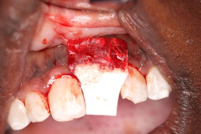 Figure 4-11: Placement of the Striate Membrane (BioHorizons) to prevent soft tissue ingrowth during the regenerative process.