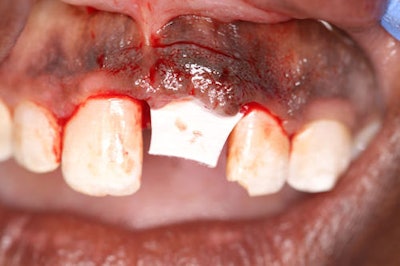 Figure 5-11: Facial tissue is approximated to assess the parameters needed for achieving primary soft tissue closure.