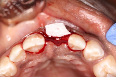 Figure 6-11: Palatal view of tissue approximation to achieve primary soft tissue closure.