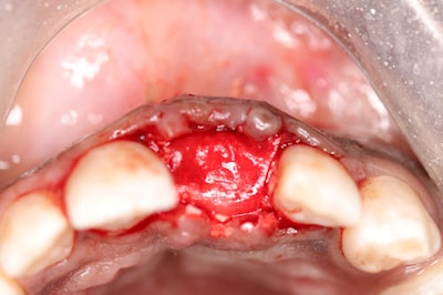 Figure 7-11: Striate+ Membrane placed over grafted bone and implant, ensuring intimate contact with the membrane.