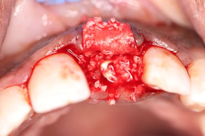 Figure 8-11: Unlike most membranes on the market, the Striate Membrane is easily cut and placed. Here, we check for proper site fill before closure.
