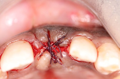 Figure 9-11: Final primary closure of the site.