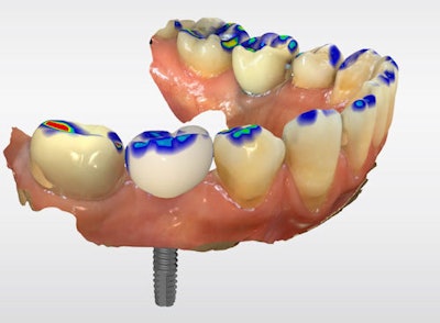 Figure 4: Digital crown design in CEREC software.