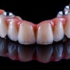 Arch Bridge Implant