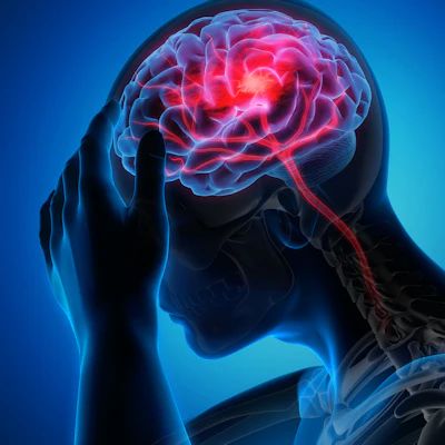 Caries, gum disease may be tied to increased stroke risk Caries, gum disease may be tied to increased stroke risk