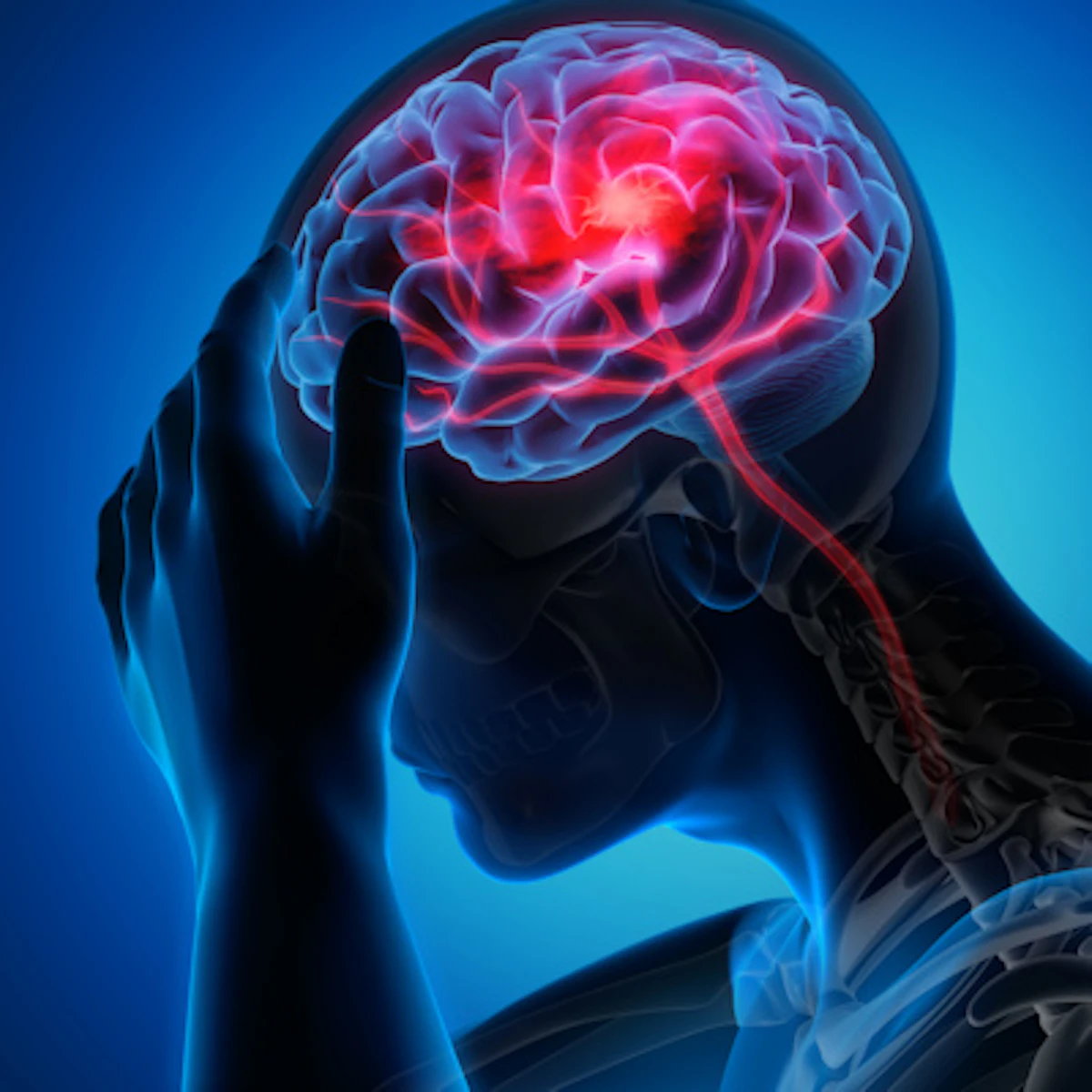 Caries, gum disease may be tied to increased stroke risk