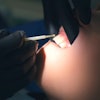 Fluoride Application Closeup