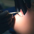 Fluoride Application Closeup