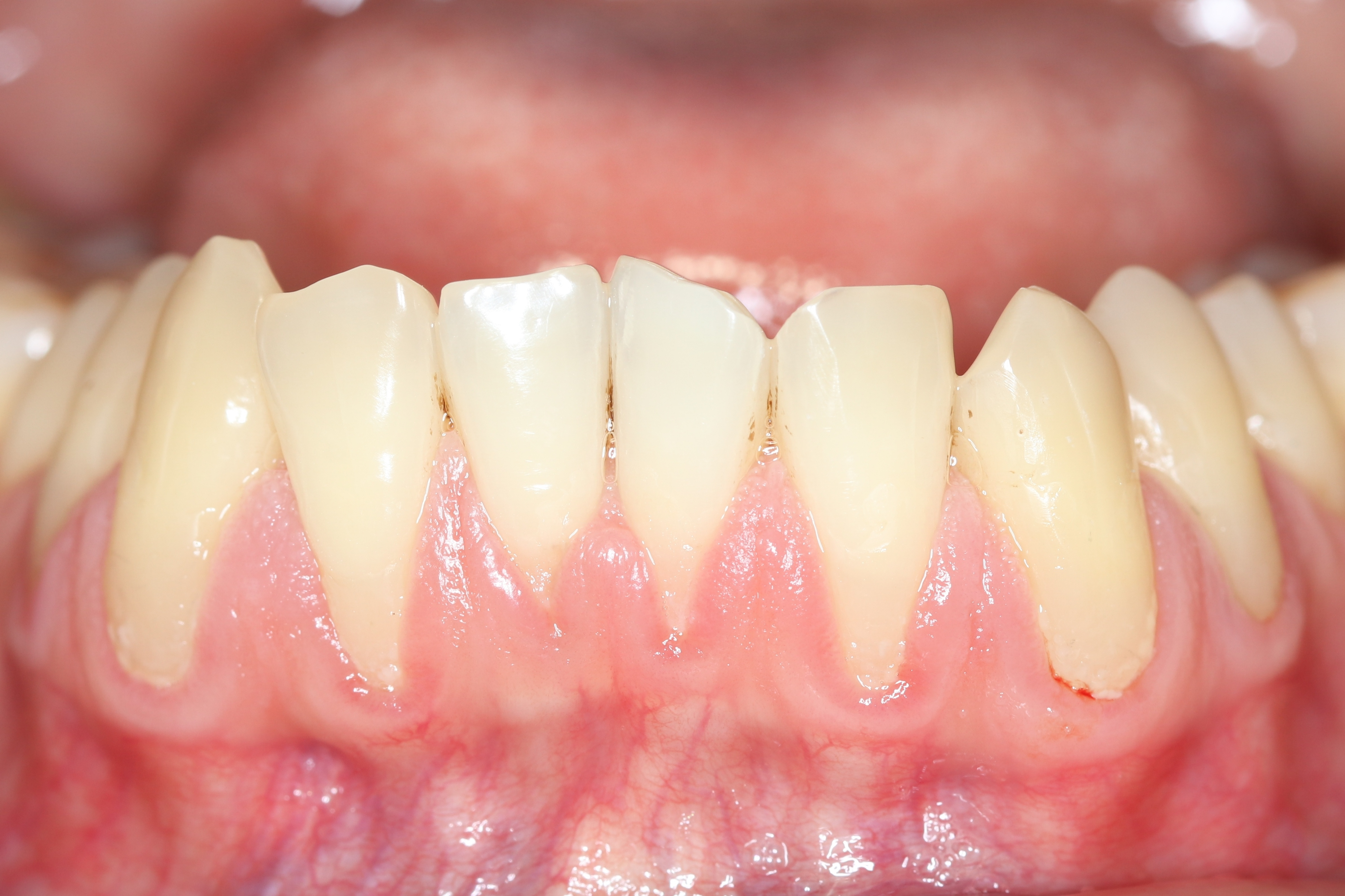 Gingival Recession Kasama