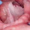 Oral Leukoplakia Dirk 400