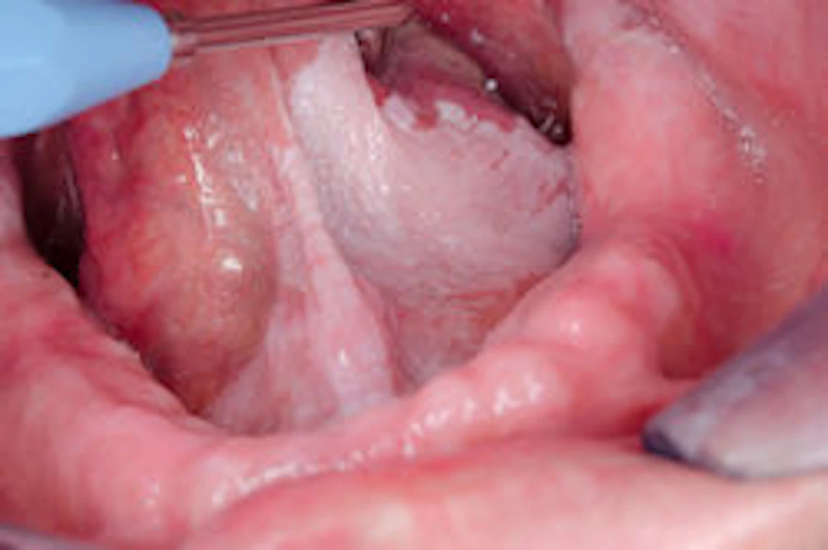 HPV may be linked to oral leukoplakia