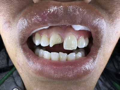Figure 1: Patient presented with an Ellis class II fracture of their central incisor #8.