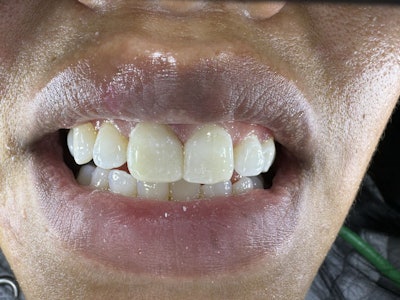 Figure 2 (bottom): The restored central incisor #8 with Ultradent Transcend composite.