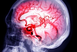 Brain Stroke Samunella