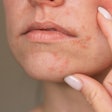 Dermatitis Mouth ольга шефер