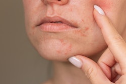 Dermatitis Mouth ольга шефер