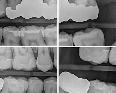 Figure 1: Four bitewings taken using the Acuity DXPD intraoral sensor.